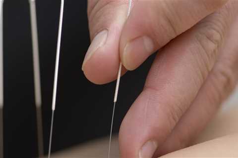 Who Should Not Get Acupuncture?