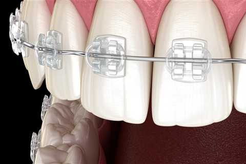 Are cosmetic braces real?