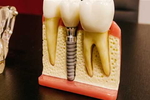 San Antonio's Restorative Dentistry Revolution: How Teeth Implants Are Changing Lives