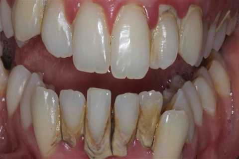 What problems do veneers cause?