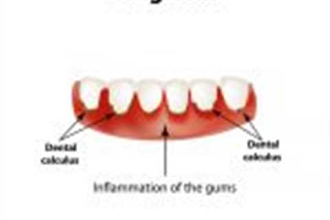 Gingivitis