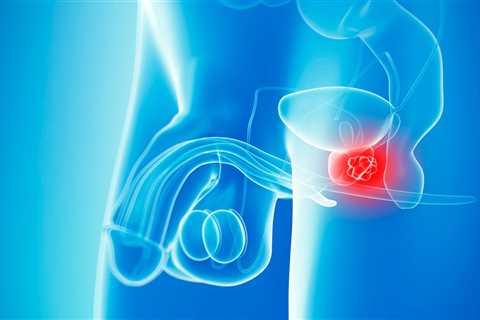 3 Questions That Can Predict Your Risk of Prostate Cancer in 30 Seconds
