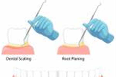 Scaling and root planing