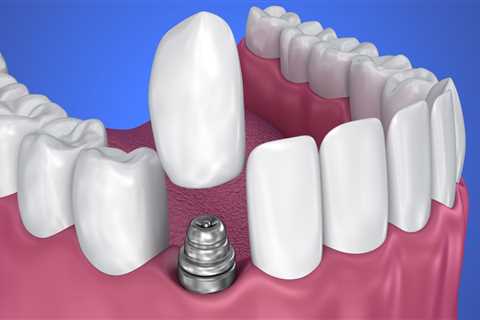 What is the most common cause of implant failure?