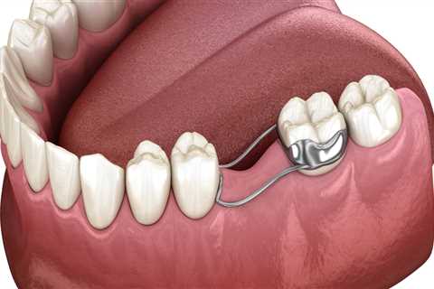 Building Beautiful Smiles: Essential Dentistry Tools For Dental Bridges In Round Rock, TX