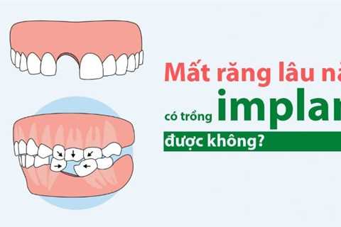 Mất răng lâu năm có trồng Implant được không? Cần lưu ý gì không? 