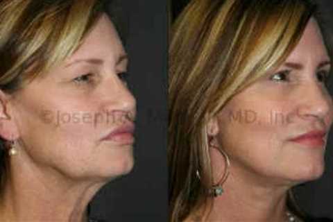 Facelifts and Eyelid Lifts in the San Francisco Bay Area (Rhytidectomy)