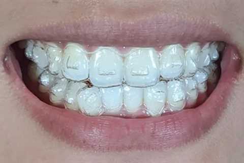 Perfect your smile discreetly with Invisalign at Dentistry on 116. Transform your look with our..