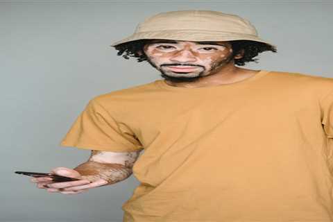 Using CBD For Relieving Symptoms Of Vitiligo