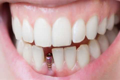 How real do dental implants look?