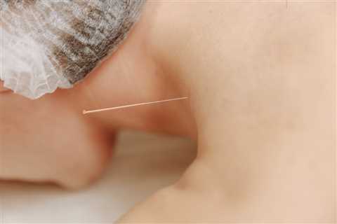 THE BENEFITS OF ACUPUNCTURE FOR DEPRESSION AND ANXIETY | Family Law Attorney Utah