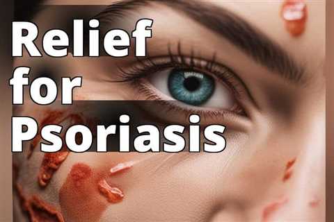 Psoriasis Relief: Unveiling the Benefits of CBD Oil