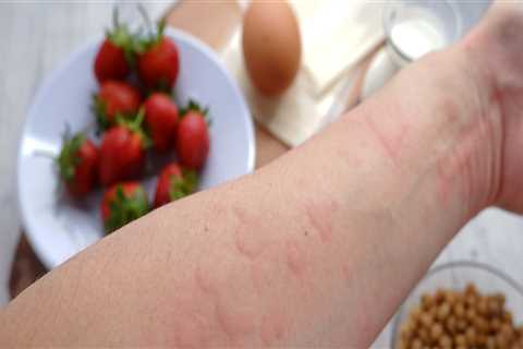 The Truth About Anaphylaxis and Food Allergies