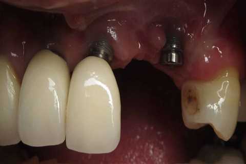 Why dental implants fail?