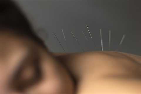 THE BENEFITS OF ACUPUNCTURE FOR CHRONIC PAIN IN ANKYLOSING SPONDYLITIS PATIENTS