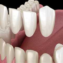 Transform Your Smile With Dental Porcelain Veneers In Sydney
