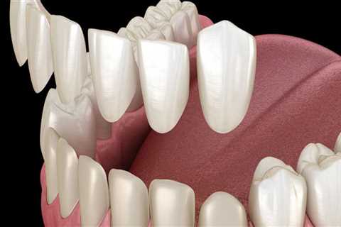 Transform Your Smile With Dental Porcelain Veneers In Sydney