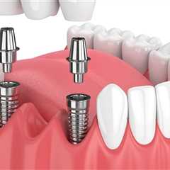 Dental Implants: The Modern Solution For Missing Teeth In Commerce City
