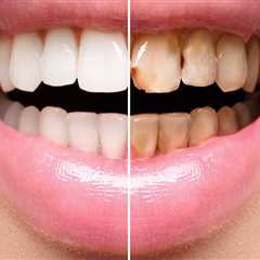 How many times can veneers be replaced?