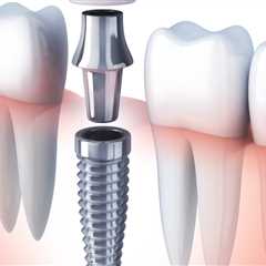 What You Need To Know About Dental Implants In Borger