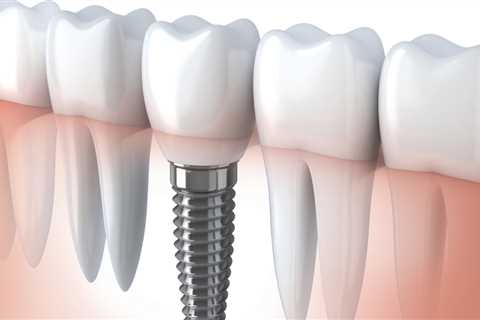 What material are dental implant teeth made of?