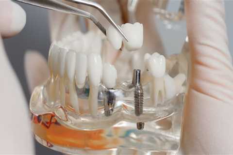 Dentist Tips And Tricks For Maintaining Your Dental Implants In Canberra