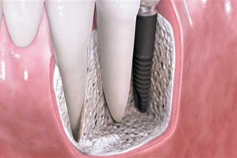 Are dental implants covered by insurance?