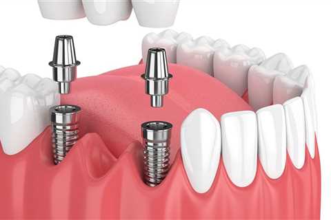 Dental Implants: The Modern Solution For Missing Teeth In Commerce City