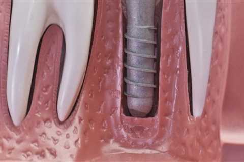 The Benefits Of Emergency Dentistry Services In Austin For Dental Implants