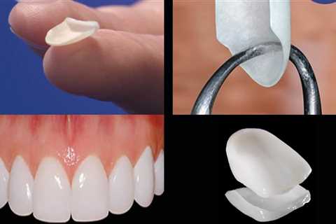 How often do you need veneers redone?