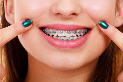 How to Whiten Teeth With Braces