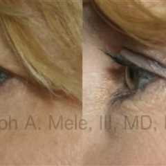 What Can Blepharoplasty Do For Your Eyelids?