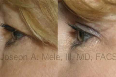 What Can Blepharoplasty Do For Your Eyelids?