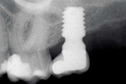 SINGLE SHORT IMPLANT IN MAXILLARY SECOND MOLAR IN AREAS OF LOW DENSITY. RETROSPECTIVE STUDY.