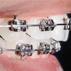 How to Keep Braces From Fading