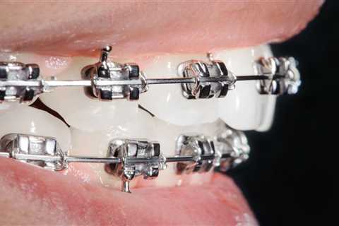 How to Keep Braces From Fading