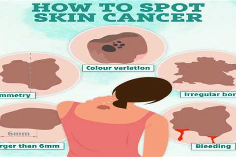 Spot on Your Face: Early Warning Sign of Cancer?