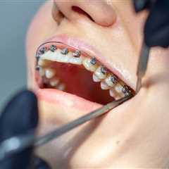 What Parents Should Know Before Choosing Braces for Their Teen in Marietta