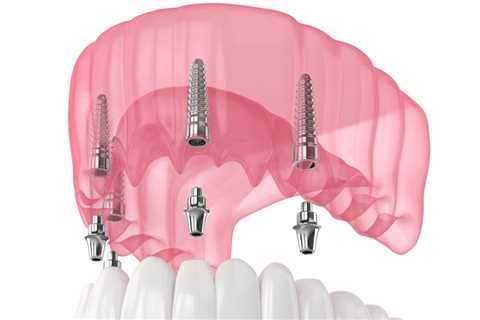 All-On-4 Dental Implants Vs. All-On-4 Dentures: Which Is Right For You In Honolulu