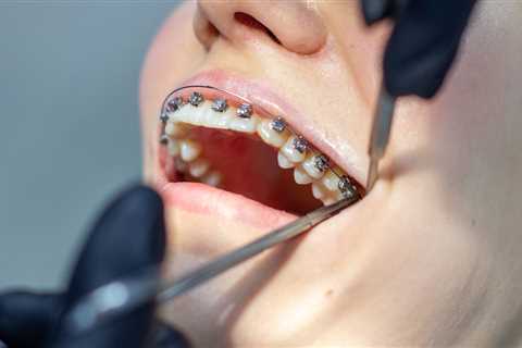 What Parents Should Know Before Choosing Braces for Their Teen in Marietta