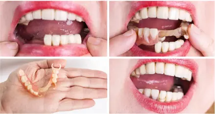 Discover the Benefits of Flexible Partial Dentures for Your Smile - Dentist Decode