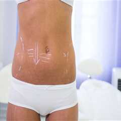 Perks Of Consulting With A Professional Medical Spa With Expertise In Laser Liposuction And Awake..