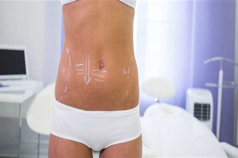 Perks Of Consulting With A Professional Medical Spa With Expertise In Laser Liposuction And Awake..