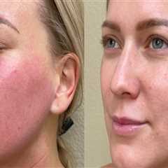From Recovery To Renewal: Plastic Surgery In Danville, California After Back Injury Challenges