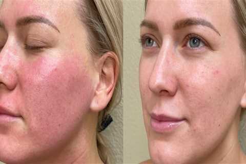 From Recovery To Renewal: Plastic Surgery In Danville, California After Back Injury Challenges