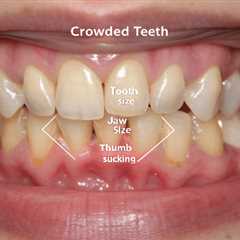 What Causes Crowding Teeth?