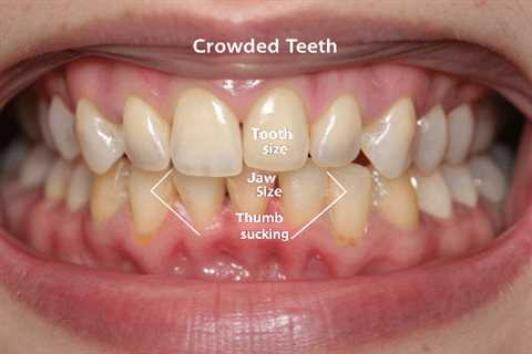 What Causes Crowding Teeth?
