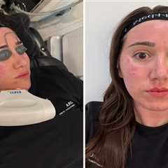 Revolutionary Laser Layering Technique: A Beacon of Hope for Skin Concerns