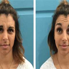 The Ultimate Guide To BOTOX In Scottsdale Medical Spas: What You Need To Know Before Your..