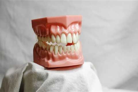 Transforming Smiles in San Diego, CA: Full Mouth Restoration Services Inspired by Dental Implants